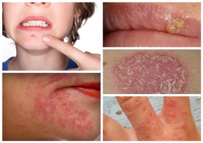 Аллергия және тері аурулары ағзадағы паразиттердің белгілері болып табылады