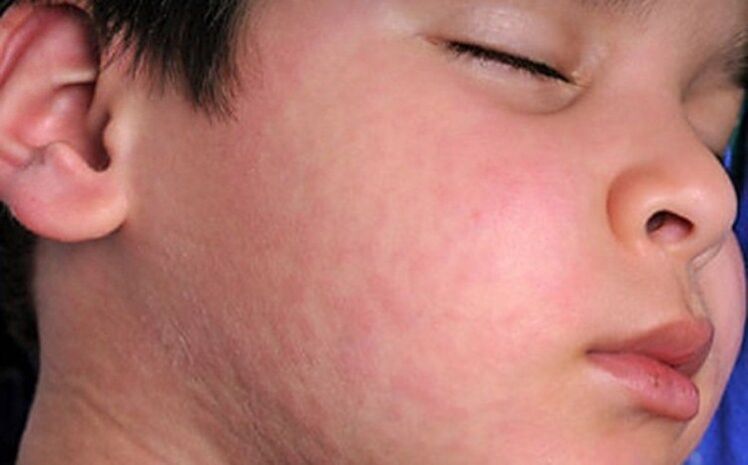 Терідегі аллергиялық бөртпелер - ағзадағы паразиттік құрттардың болуының симптомы